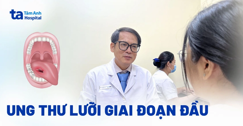 Ung thư lưỡi giai đoạn đầu có chữa được không và những dấu hiệu nhận biết sớm