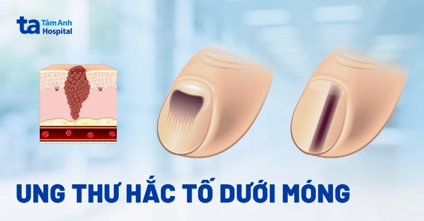 Ung thư móng tay có chữa được không? Dấu hiệu, nguyên nhân và cách điều trị
