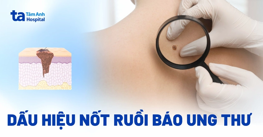 Ung thư mụn ruồi: Dấu hiệu nhận biết và cách phòng ngừa hiệu quả