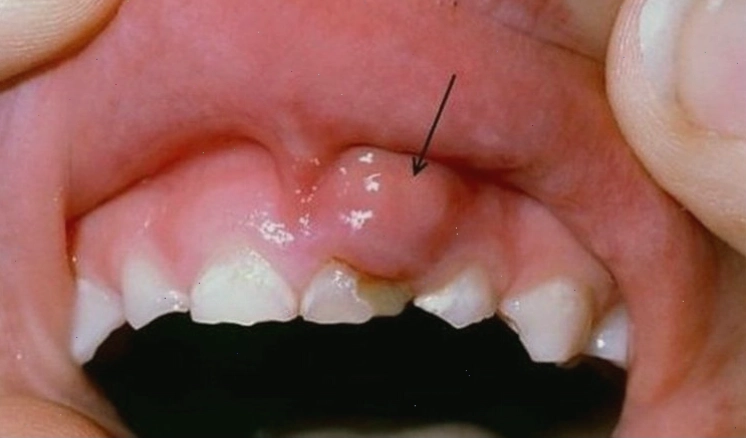 Ung thư nướu răng là một trong nhóm các bệnh ung thư của khoang miệng