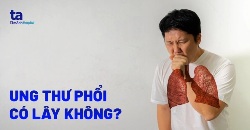 Ung thư phổi có lây không? Giải đáp chi tiết từ chuyên gia