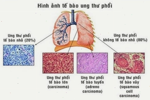 Ung thư phổi được chia làm 2 loại chính: ung thư phổi tế bào nhỏ và ung thư phổi không tế bào nhỏ