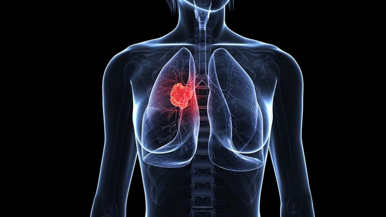 Ung thư phổi không đột biến gen: Hiểu đúng về chẩn đoán, nguy cơ và hướng điều trị