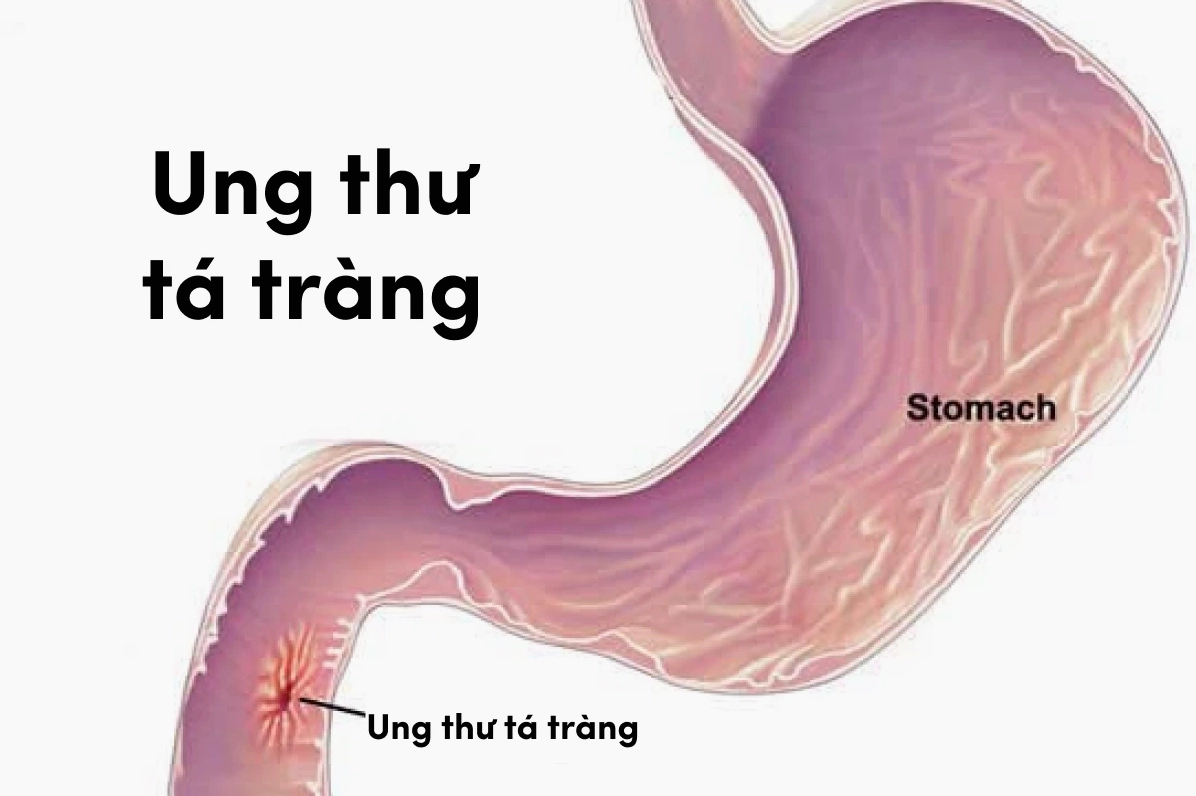Ung thư tá tràng có nguy hiểm không? Nhận biết sớm và phòng tránh hiệu quả