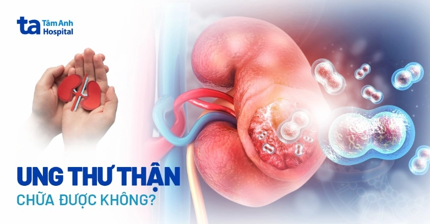 Ung thư thận có chữa được không Tùy Giai Đoạn và Phương Pháp Điều Trị