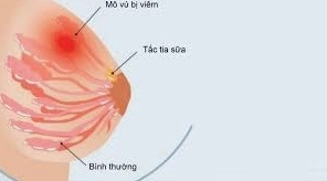 Ung thư thanh quản hạ họng: Chẩn đoán, Điều trị và Phòng ngừa