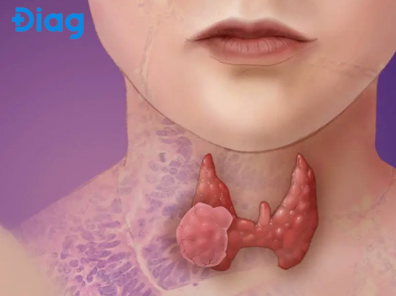 Ung thư tuyến giáp dạng nhú: Thông tin chi tiết và cách quản lý hiệu quả