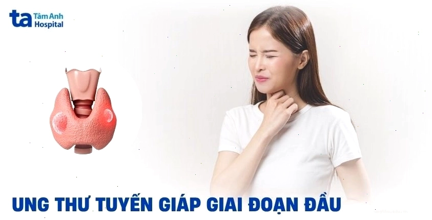 Ung thư tuyến giáp giai đoạn đầu.