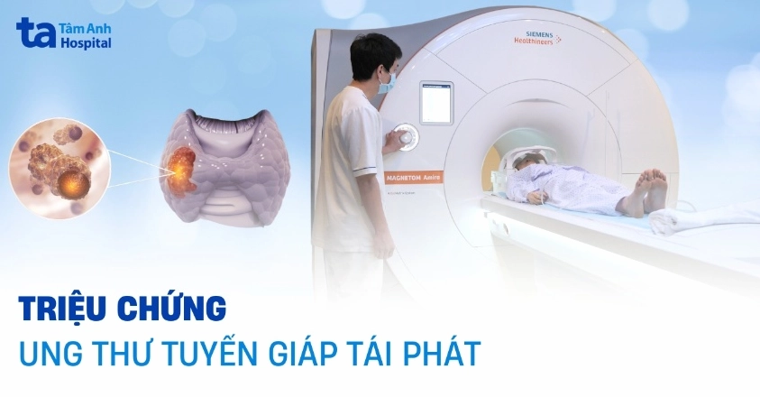 Ung thư tuyến giáp tái phát hạch cổ: Triệu chứng, dấu hiệu và cách nhận biết sớm