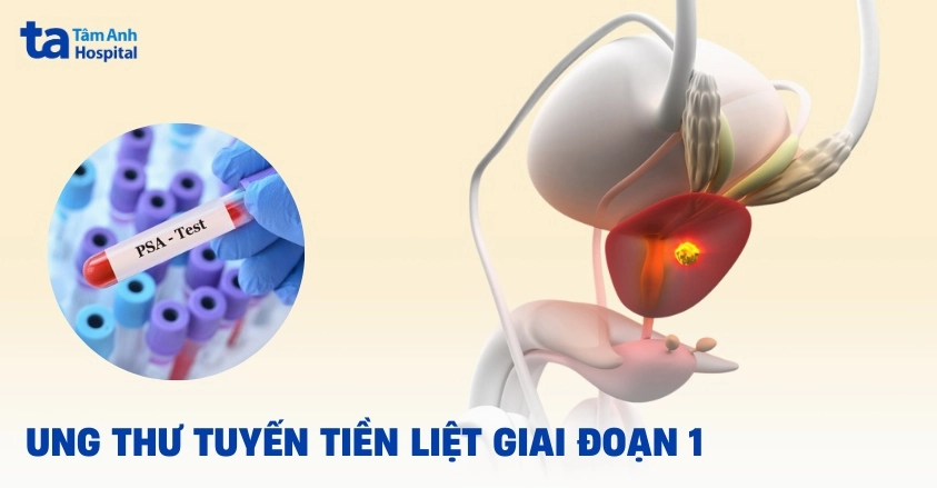 Ung thư tuyến tiền liệt sống được bao lâu? Các yếu tố ảnh hưởng và tiên lượng