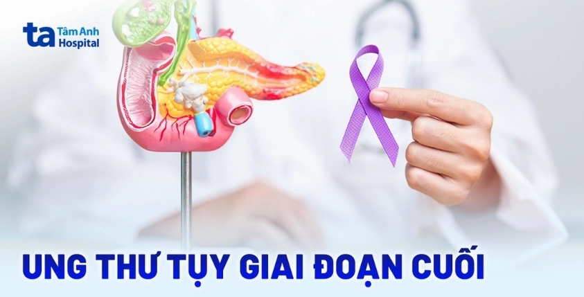 Ung thư tuyến tụy sống được bao lâu? Các yếu tố ảnh hưởng và tiên lượng