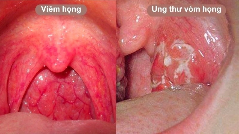 Ung thư vòm họng những dấu hiệu nhận biết sớm và phương pháp điều trị