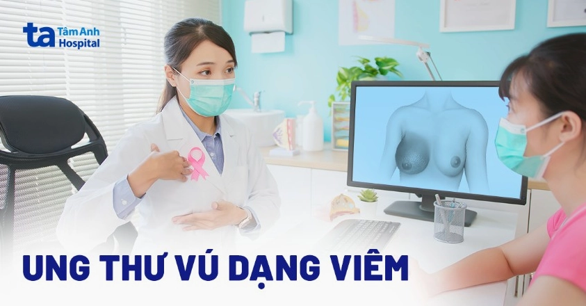 Ung thư vú dạng viêm IBC: Dấu hiệu nhận biết và cách phòng ngừa