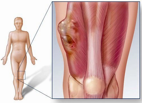 Ung thư xương cánh tay: Nguyên nhân, triệu chứng và phương pháp điều trị