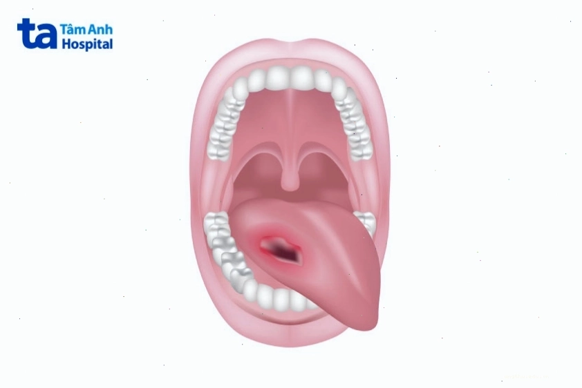 Vết loét lâu lành trên lưỡi là dấu hiệu ung thư lưỡi giai đoạn đầu