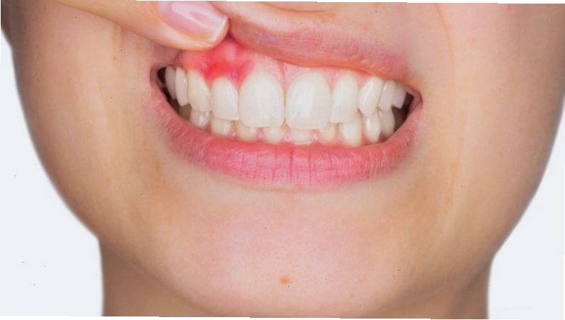 Vết loét trên nướu gây đau khi chạm vào