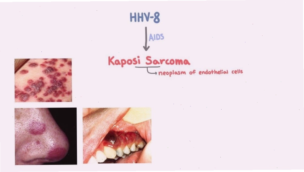 Virus herpes 8 (HHV8) là tác nhân chính gây ra ung thư Kaposi