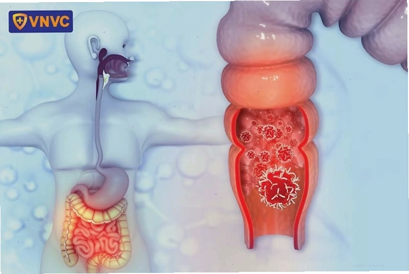 Virus HPV là nguyên nhân chính gây ung thư hậu môn