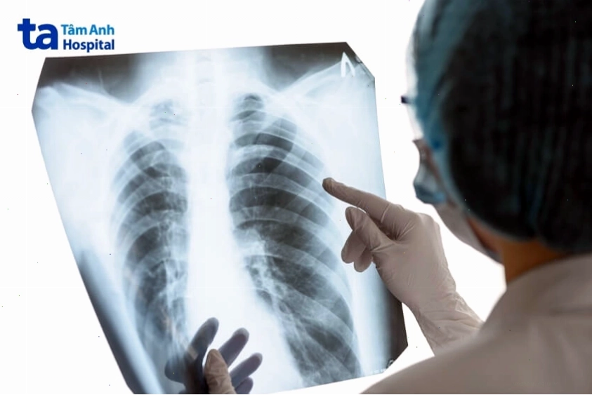 X-quang hỗ trợ chẩn đoán ung thư phổi và các bệnh lý về xương