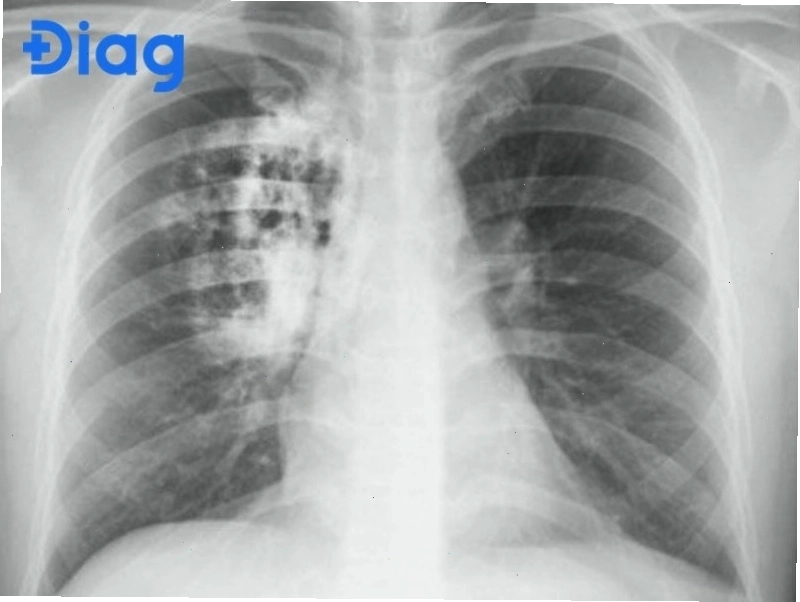 X-quang ngực cho thấy khối u phổi dưới dạng bóng mờ bất thường