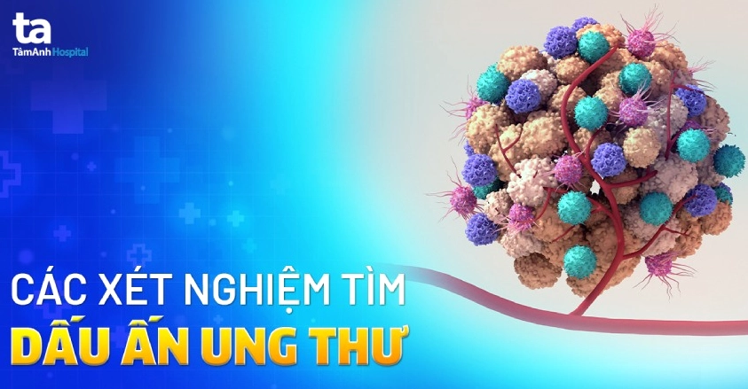 Xét nghiệm mắc cơ ung thư: Phát hiện sớm, nâng cao cơ hội điều trị