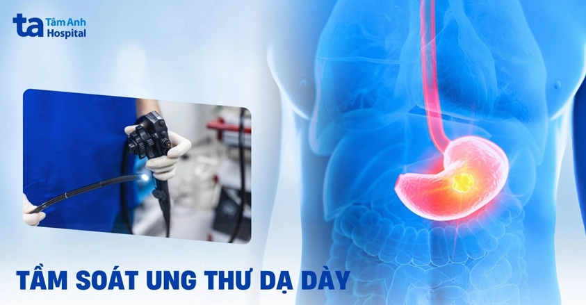Xét nghiệm ung thư dạ dày bằng cách nào để phát hiện sớm?