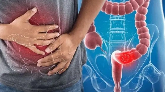 Xét nghiệm ung thư đại trực tràng: Khám phá phương pháp và chỉ số cần biết